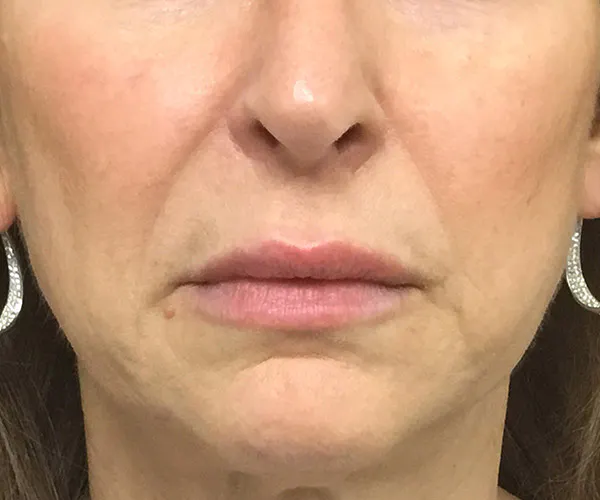 Dermal Fillers
