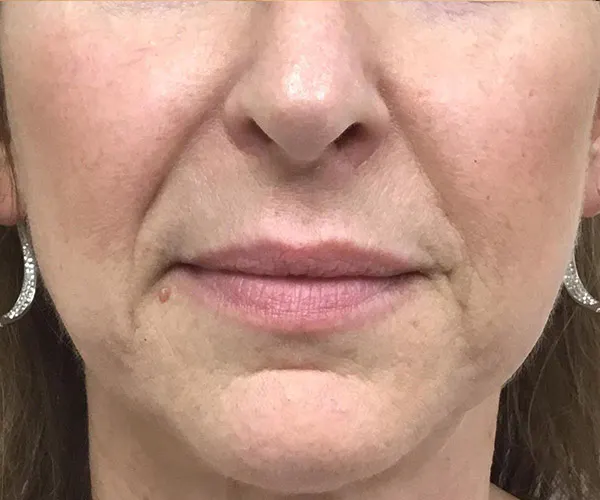 Dermal Fillers