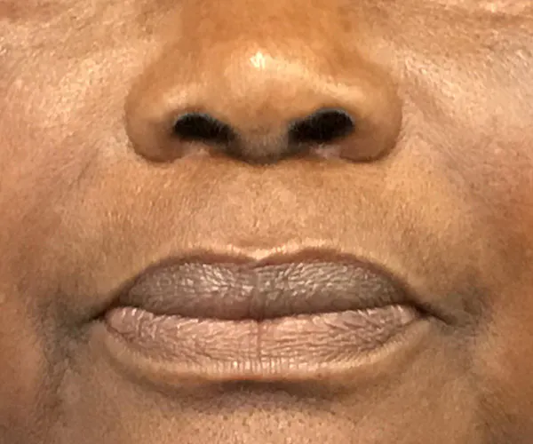 Dermal Fillers