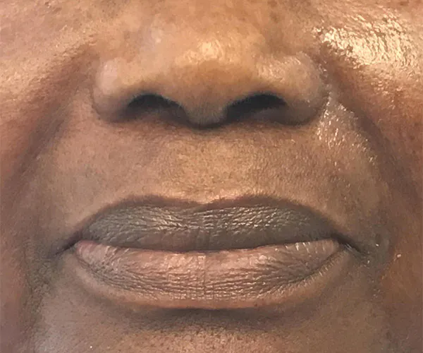 Dermal Fillers